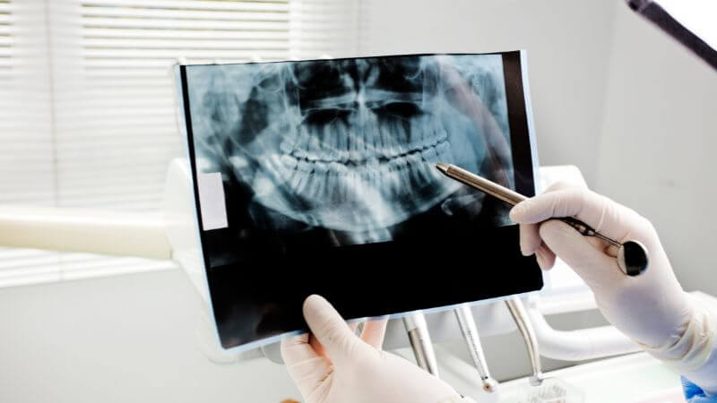 pellicola radiografia per dentisti deposito martellago